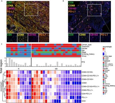 Low Infiltration of CD8+ PD-L1+ T Cells and M2 Macrophages Predicts Improved Clinical Outcomes After Immune Checkpoint Inhibitor Therapy in Non-Small Cell Lung Carcinoma